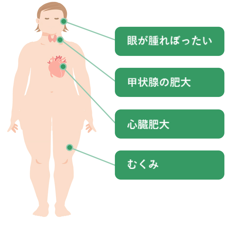 甲状腺機能低下の特徴イラスト